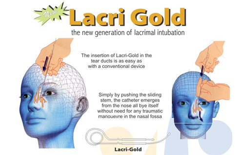 lacrimal intubation set lacri gold